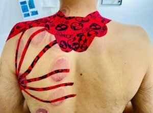 ויקטור חכמון - קנזיוטיפינג