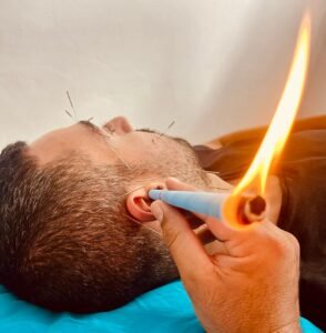 ויקטור חכמון - דיקור סיני